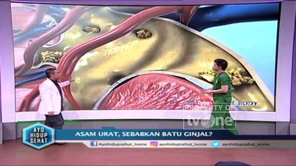 "Asam Urat, Sebabkan Batu Ginjal?" - Ayo Hidup Sehat