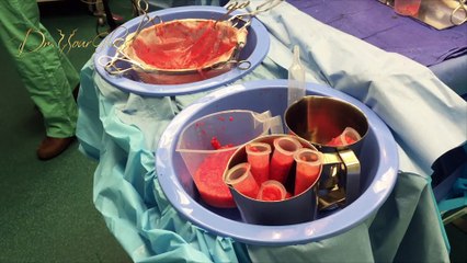 How is fat transfer to the buttocks performed?