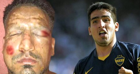 Arjantinli Golcü, Yüzünde Patlayan Havai Fişek Sonrası Tanınmaz Hale Geldi