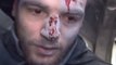 Syrian Journalist Wounded by Blast While Reporting on Strikes in East Ghouta