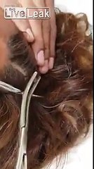 Extraction d'une balle de revolver de son crane au Mexique !