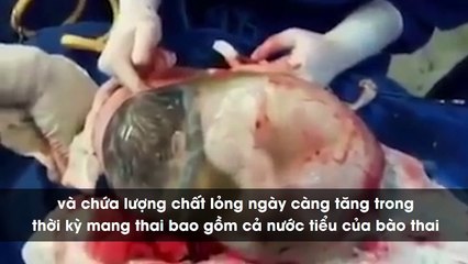 Sự thật thú vị về những em bé sinh ra trong "bọc điều" 80.000 ca có 1