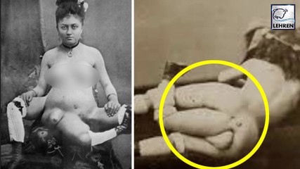 Story Of A French Woman With Unbelievable Extra Body Parts