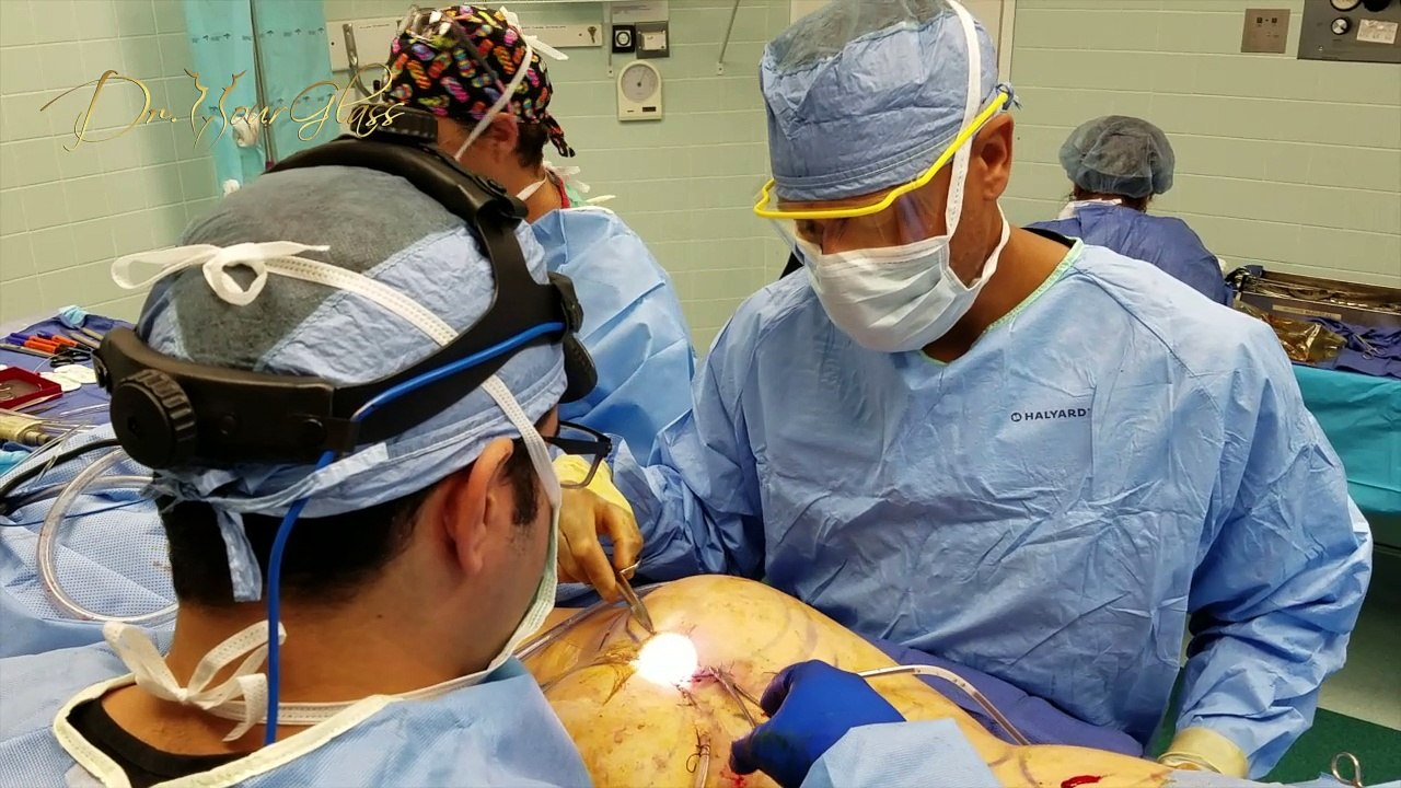 Are butt implants better than fat grafting?