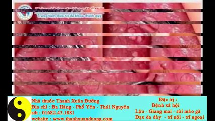 Bệnh lậu ở nữ giới và cách chữa khỏi hoàn toàn