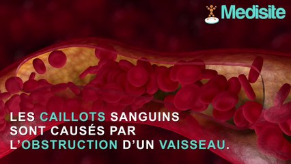 Caillot sanguin : quels sont les signes ?
