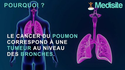 Cancer du poumon : les signes d’alerte