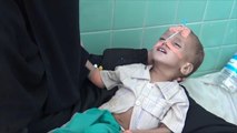 يونيسيف: 2.2 مليون طفل يمني يعانون سوء التغذية