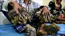 Bangladesh's 'Tree Man' has surgery to remove warts