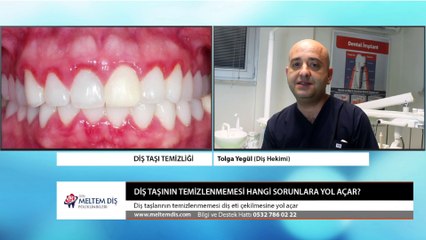 Diş Taşı Temizliği - Tartar Temizleme