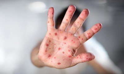 471 Anak Terkena Campak dalam Waktu 5 Bulan di Asmat