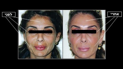 ד"ר רוברטו ליפשיץ - בוטוקס | הזעת יתר | שקיות מתחת לעיניים | בוטוקס בשפתיים