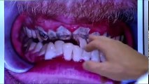 20 ans sans se brosser les dents, son dentiste découvre la catastrophe