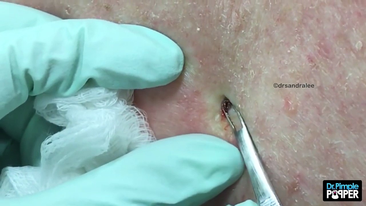 Because we're into Blackheads...