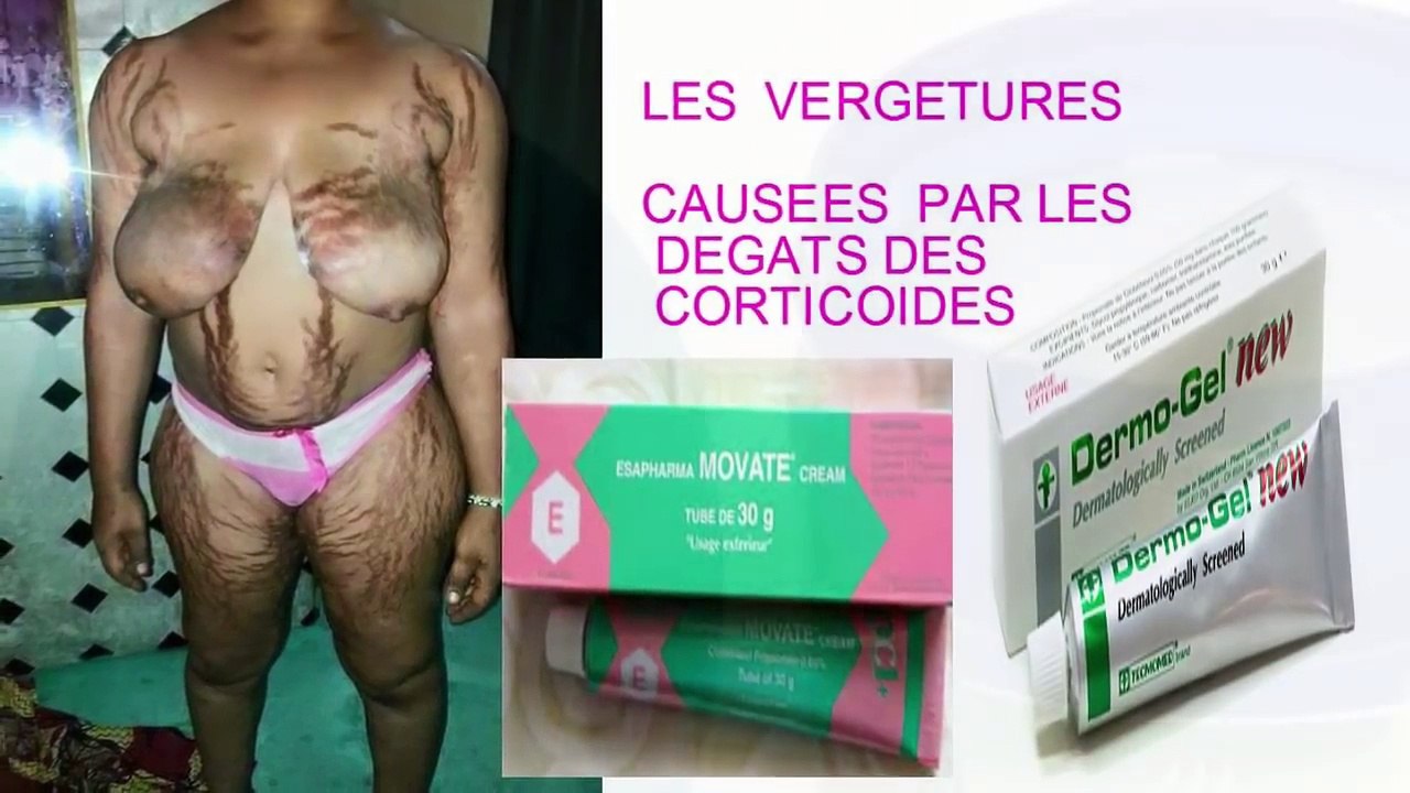 Traitement Efficace Des Vergetures et Dégâts Corporels Dû Aux Corticoïdes