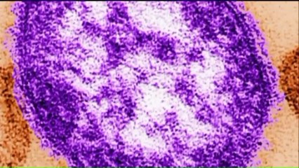 Second Case of Measles Reported at Chicago's  O'Hare Airport