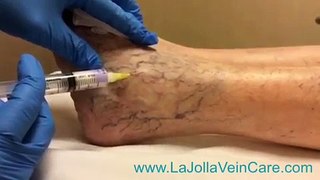 Spider Vein Sclerotherapy Treatment