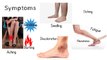 What Causes Varicose Veins? Who Gets Varicose Veins?