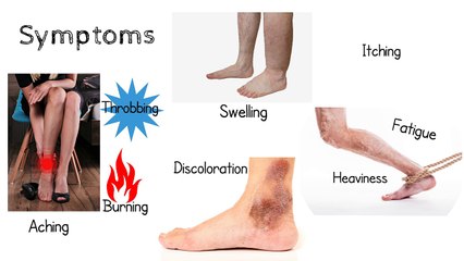 What Causes Varicose Veins? Who Gets Varicose Veins?