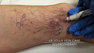 Sclerotherapy Spider Vein Injections