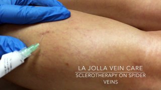 How To Remove Spider Veins San Diego