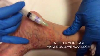 TOP 5 Sclerotherapy Videos of 2017: #4
