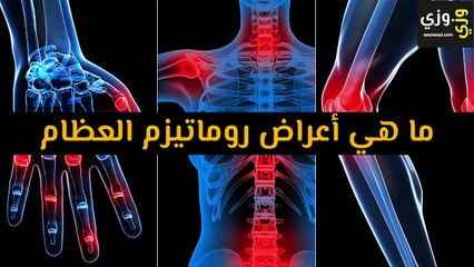 أعراض روماتيزم العظام