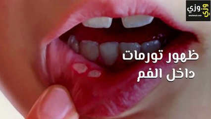 أعراض سرطان اللسان