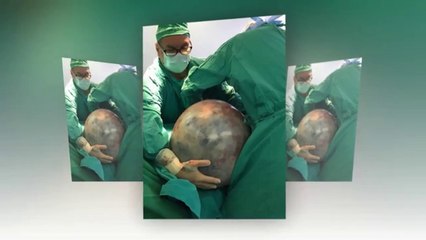 Ameliyatını 8 Yıl Boyunca Erteledi, Karnından 34 Kiloluk Tümör Çıkartıldı