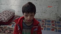Adana Varil Bombasıyla Vücudu Yanan Mahmud Estetik Ameliyat İstiyor