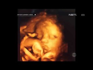 Ashanti curhat tentang suntik pengecer darah