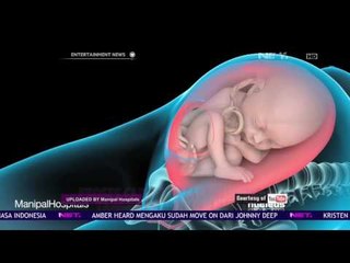 Metode Persalinan Bayi yang Kian Beragam