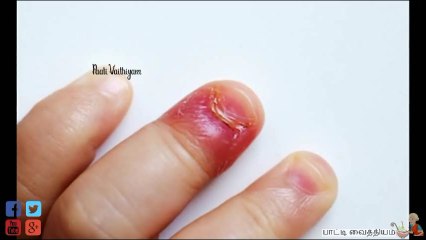 நக சுத்தியா??இனி கவலை வேண்டாம்!!| பாட்டி வைத்தியம்|NagaSuthi Home Remedies