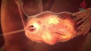 How Pregnancy Happens With IVF Techniques Se   How IVF (In-Vitro) Works | 3D Animation