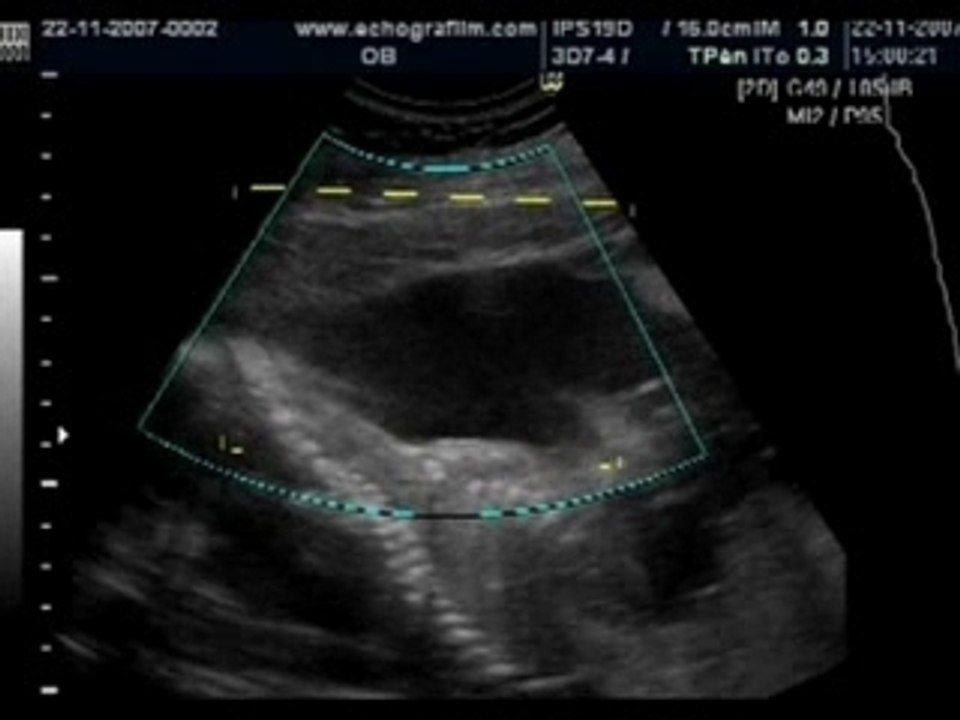 Echographie affective Sothea