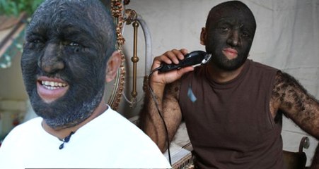 Suratının Yüzde 98'i Kıllarla Kaplı! Dünyanın En Kıllı İnsanı Artık Çok Mutlu