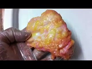 Breast Implant Surgery in Delhi by Vital Clinic