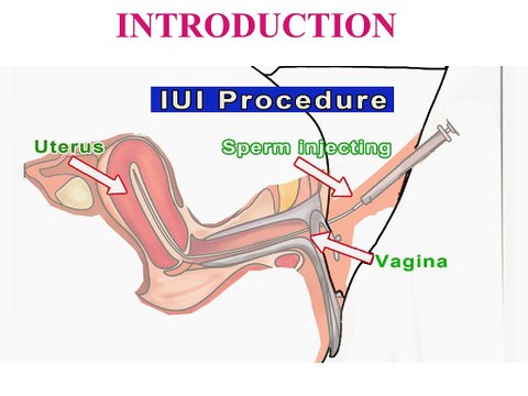 IUI Treatment in Hyderabad – IUI Infertility Centre in Hyderabad