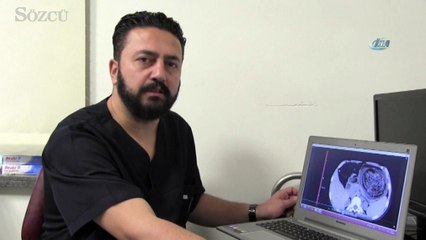 12 yaşındaki kızın midesinden top büyüklüğünde saç ve sakız yumağı çıkarıldı