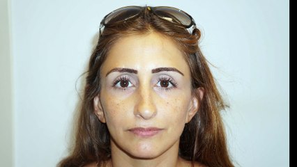 Mustafa Ali Yanık burunda şekil bozukluğu şikayet ile başvuran hastaları ve sonuçlarını paylaşıyor