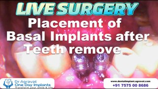 Lower Front Mobile Teeth remove & Replacement with Basal Implants | How dental Implants surgery are Done in Ahmedabad, India.