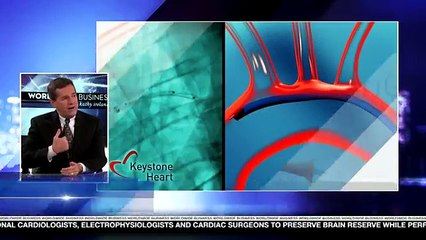 Embolic Cerebral Protection Devices - Keystoneheart.com