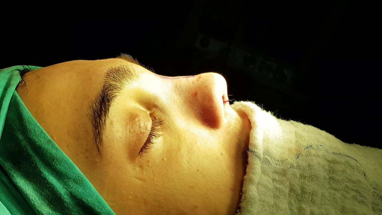 Op Dr Mustafa Ali Yanık Başarılı bir burun estetiğinin önemini anlatıyor. Mustafa Ali Yanık burun şikayet ve çözümleri