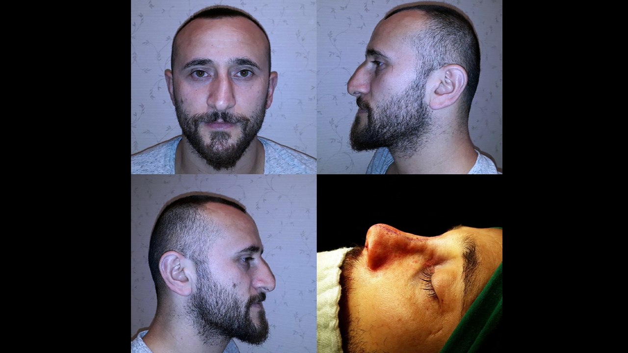 Op Dr Mustafa Ali Yanık Başarılı bir burun estetiğinin önemini anlatıyor. Mustafa Ali Yanık burun şikayet ve çözümleri