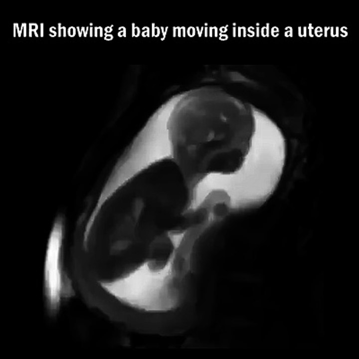 Il Enregistre Les Mouvement D Un Bebe Dans Le Ventre De Sa Maman Agite Video Dailymotion