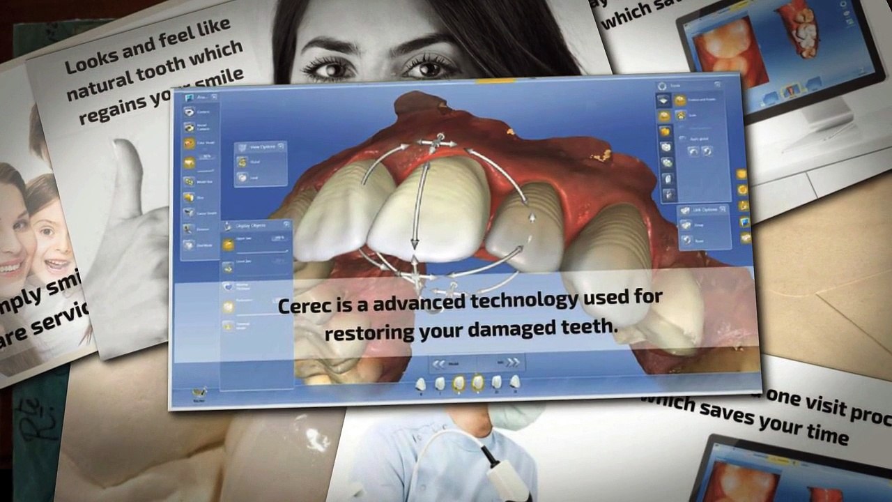 Affordable Cerec Crowns Dentist in Palmetto Bay