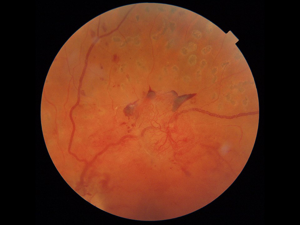 6 respuestas claras sobre Retinopatía Diabética