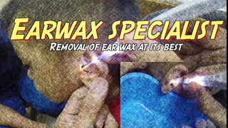 Piece by Piece Earwax Extraction with Lighted Ear Curette