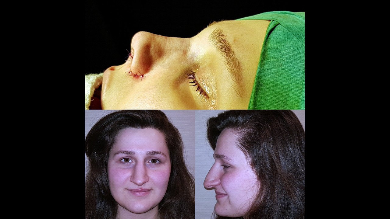 Mustafa Ali Yanık  burunda şekil bozukluğu şikayet ile başvuran hastaları ve sonuçlarını paylaşıyor