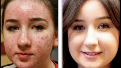 Treatment for Acne Scars